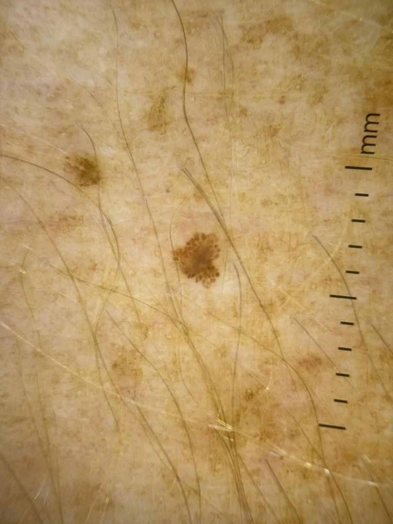 The melanoma from the forearm through a dermatoscope: a small brown spot about 2 mm across, beside a millimetre scale.