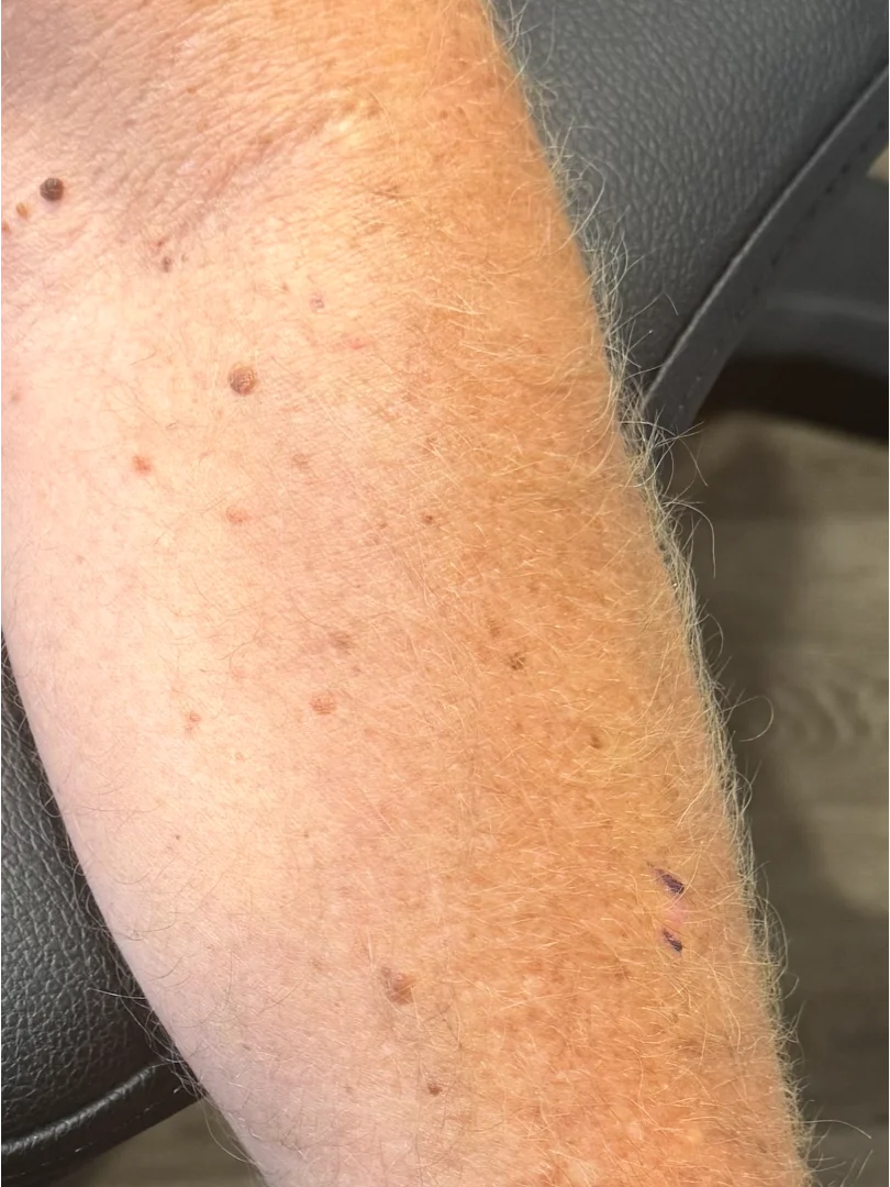 A patient’s forearm, freckled and sun-damaged, with nothing that obviously stands out.