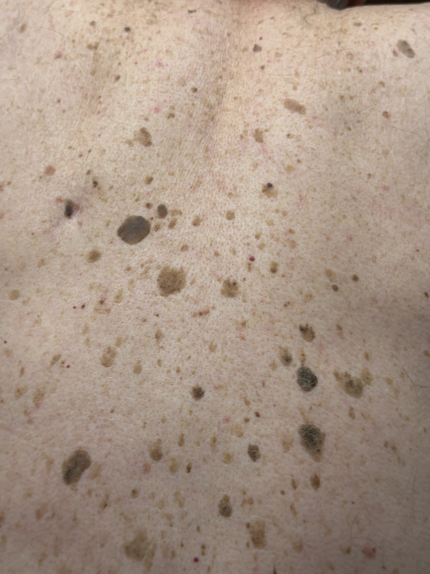 A patient’s back, covered in moles and freckles, with three similar brown spots circled.