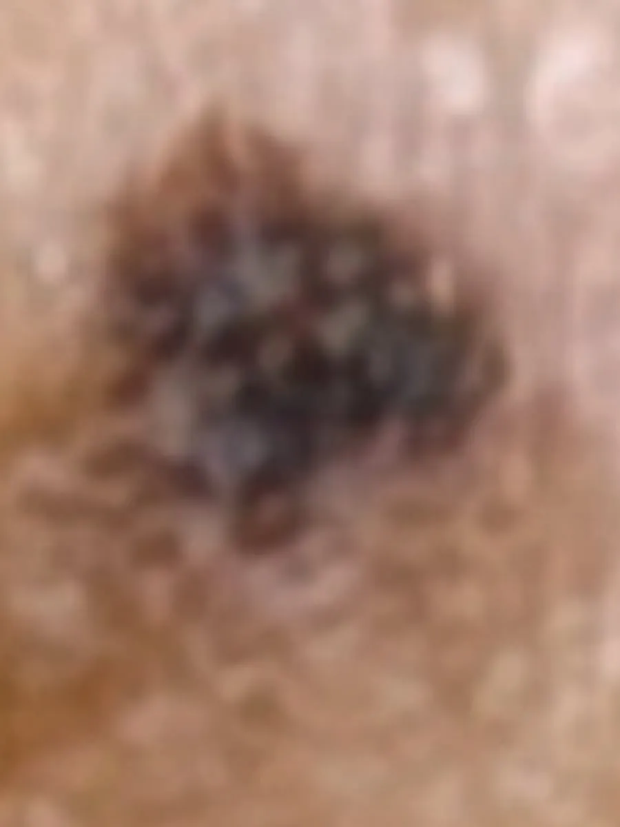 A brown spot on a patient’s back, as the naked eye sees it