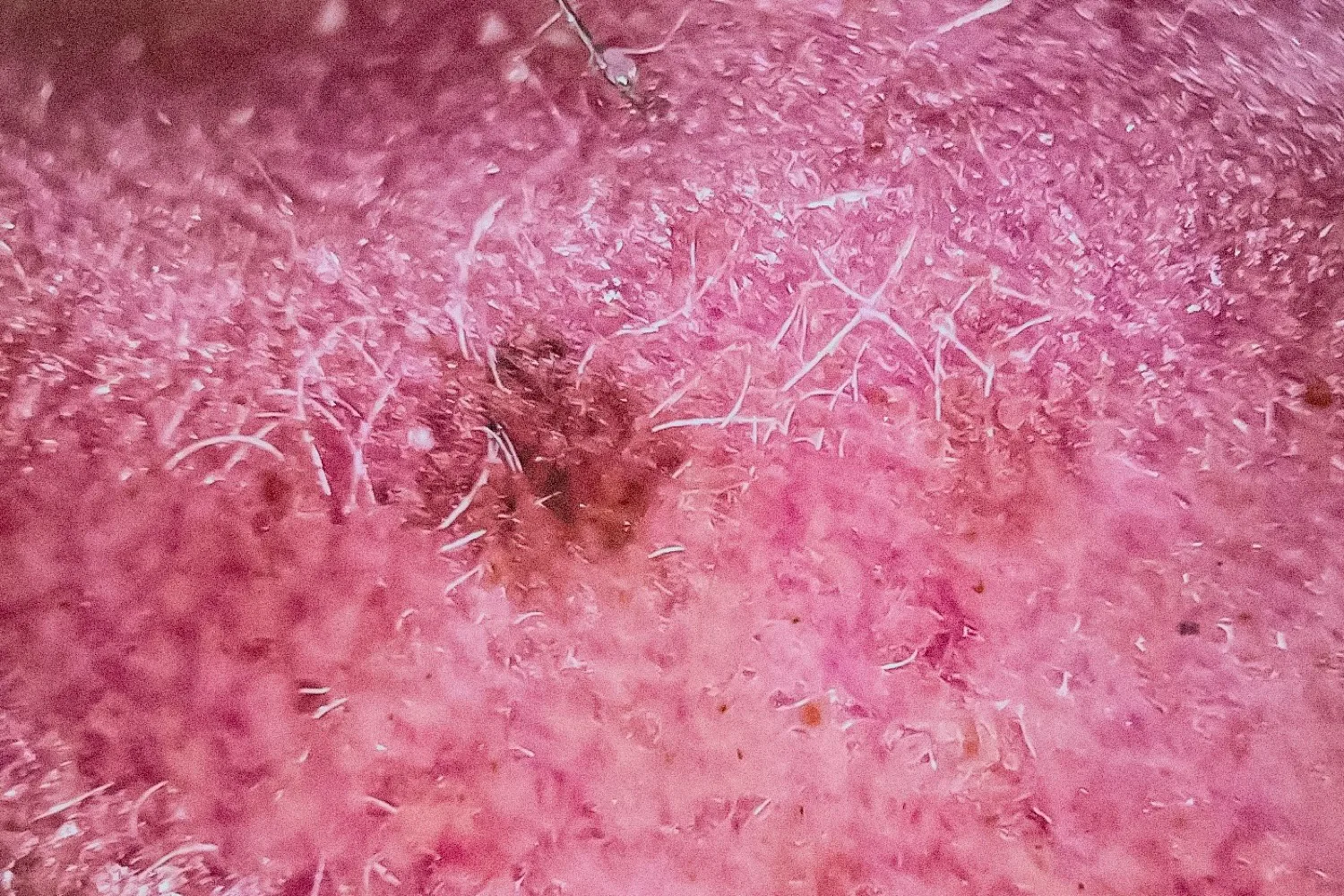 A dermoscopy view of a small brown spot on pink, sun-damaged skin.